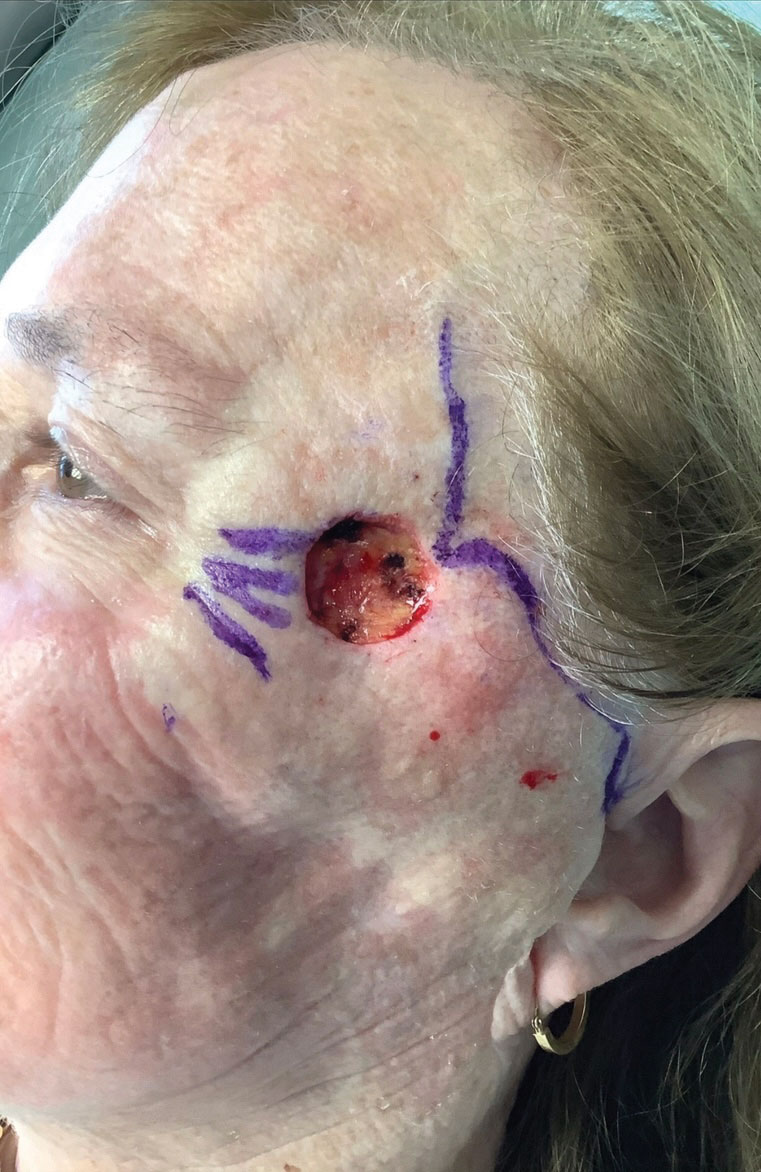 Amelanotic melanoma on the temple. Photo: Deborah S. Sarnoff, MD