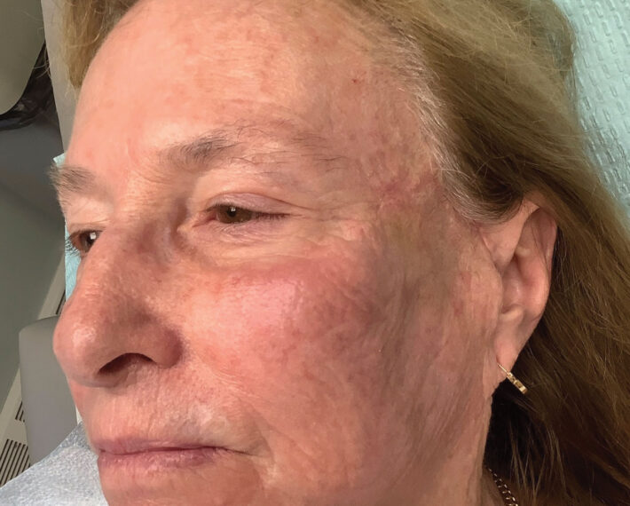 7.-One-month-after-suture-removal
