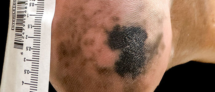 Acral lentiginous melanoma on heel of foot