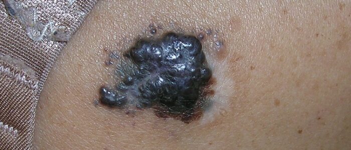 Dark, raised melanoma