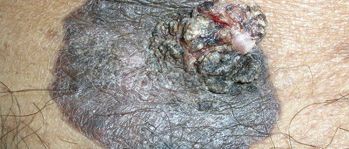 Large pigmented squamous cell carcinoma Large pigmented squamous cell carcinoma