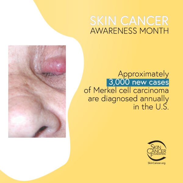 Approximately 3,000 new cases of Merkel cell carcinoma are diagnosed annually in the U.S.