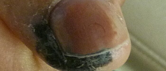 Melanoma on finger
