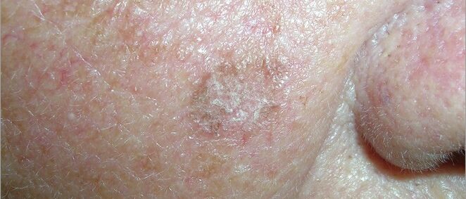 Squamous cell carcinoma, scaly patch on cheek
