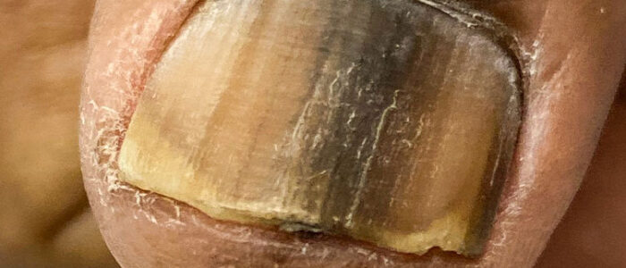 Subungual melanoma under toenail