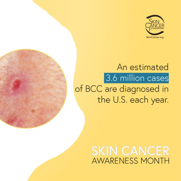 An estimated 3.6 million cases of BCC are diagnosed in the U.S. each year