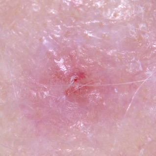 A nodular melanoma developing within an amelanotic melanoma in situ on the scalp.