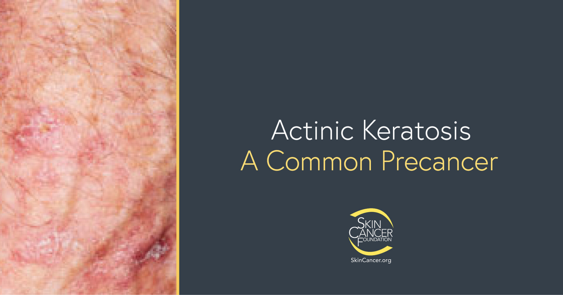 Actinic Keratosis Treatment - The Skin Cancer Foundation